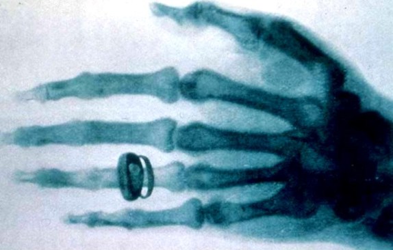 x-ray_by_wilhelm_rontgen_of_albert_von_kollikers_hand